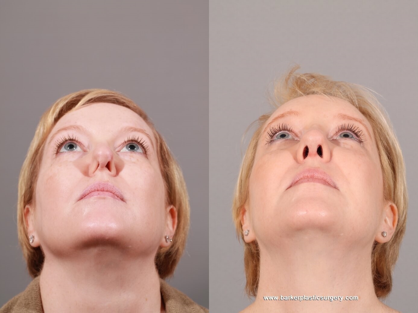 revision rhinoplasty before and after