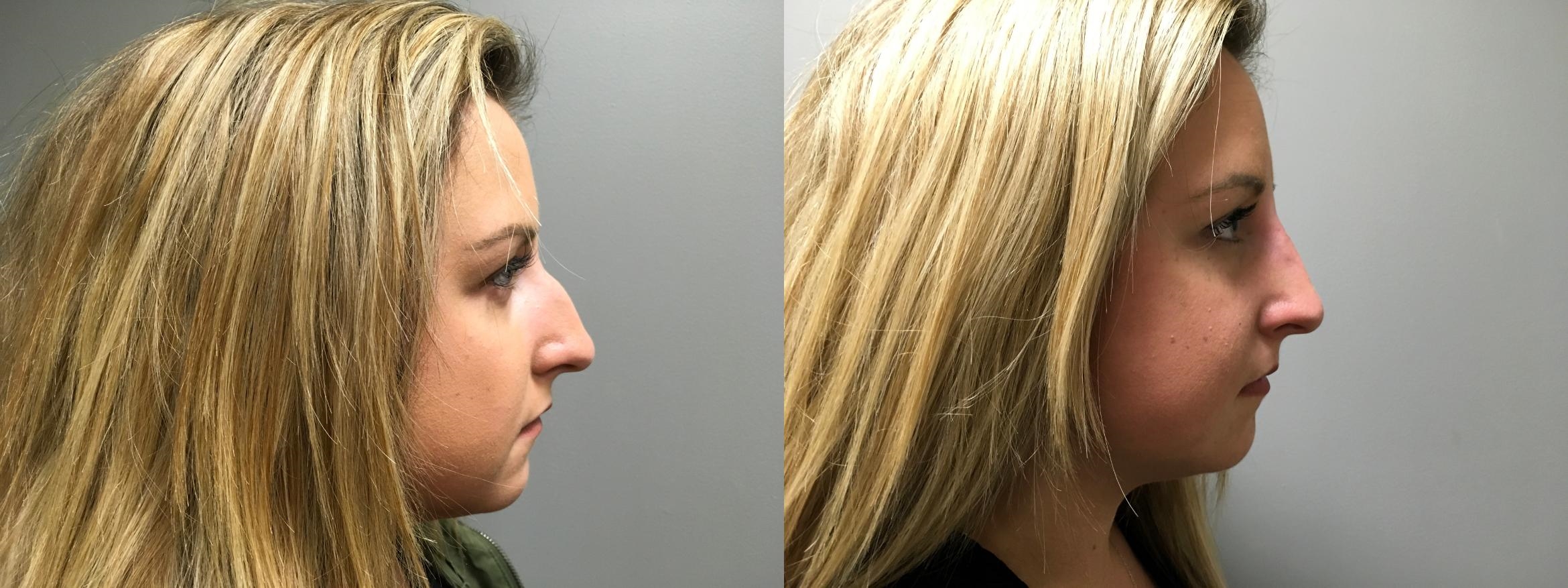 revision rhinoplasty before and after