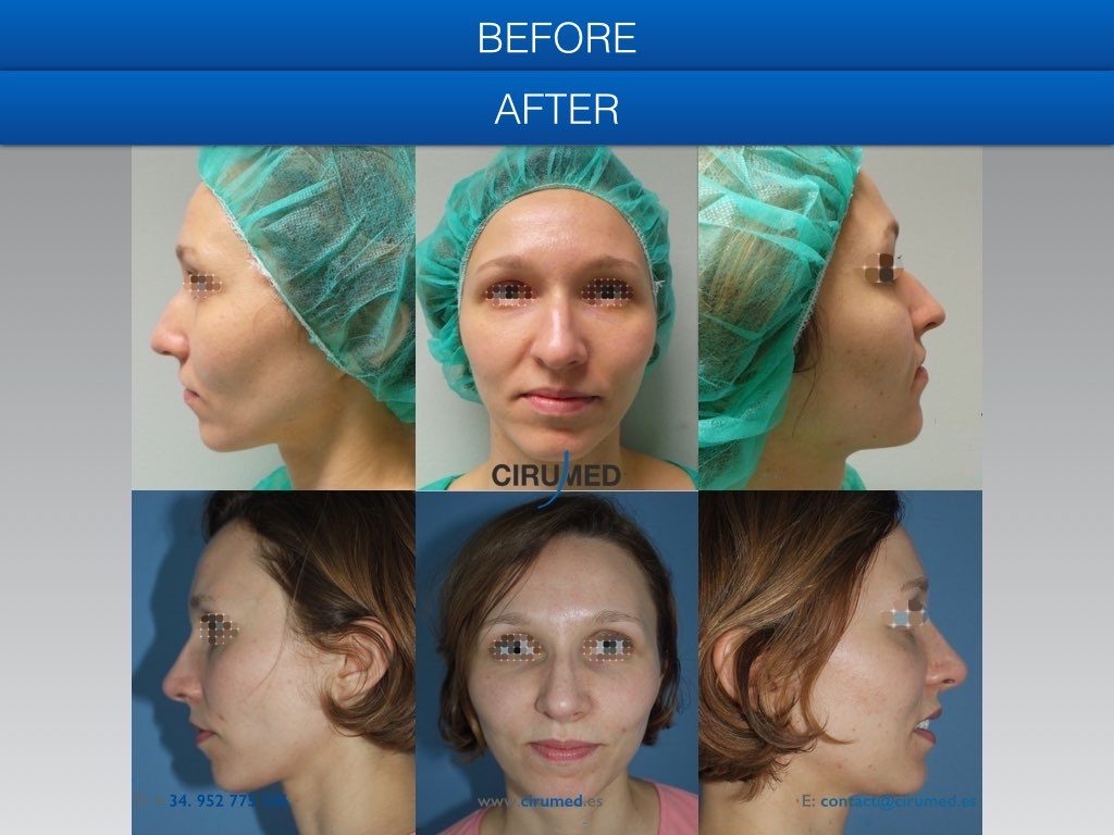 revision rhinoplasty before and after